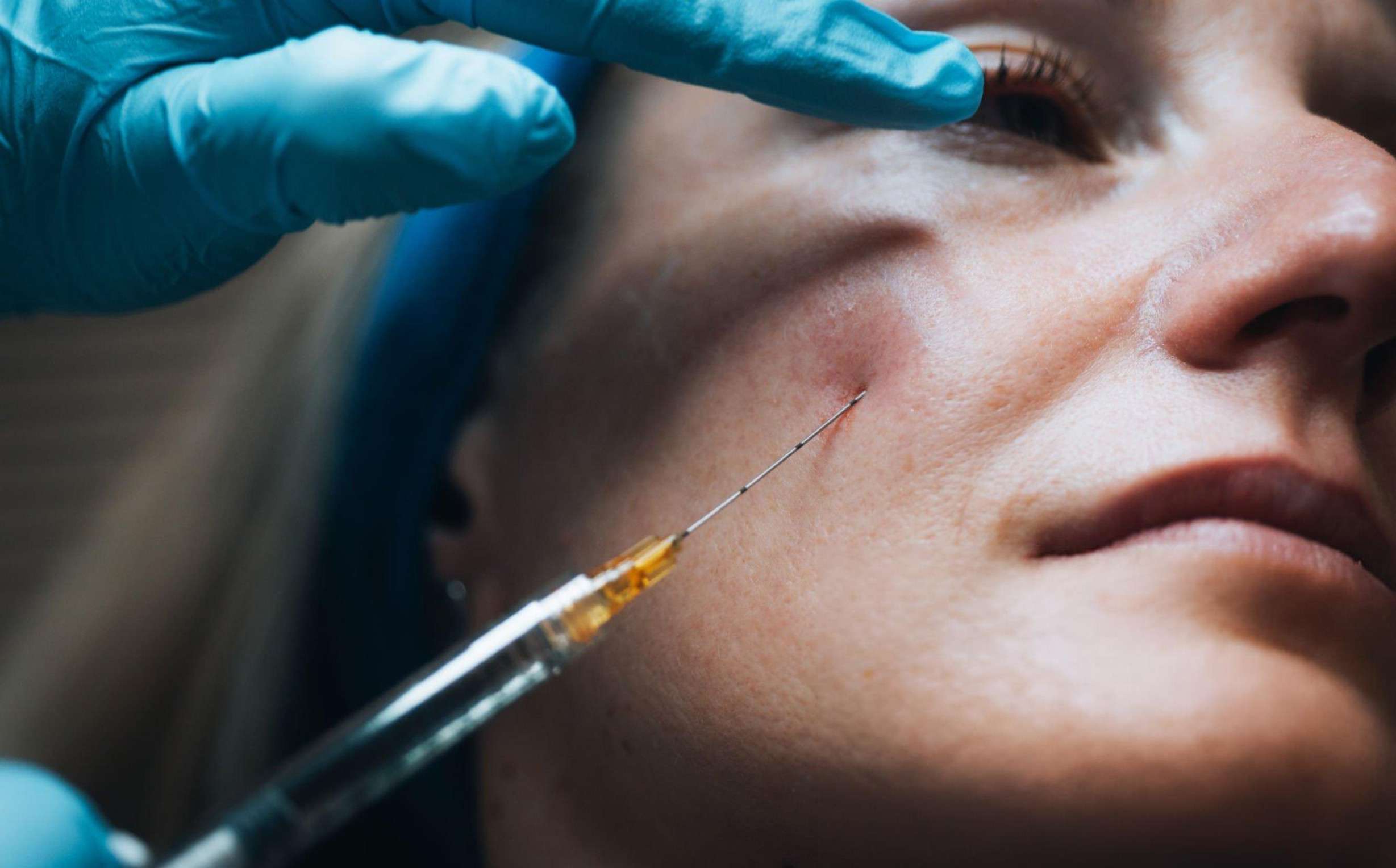 Cheek filler results